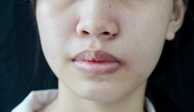 Nhiều phụ nữ bị loét da, phù mặt do muốn làm đẹp nhanh