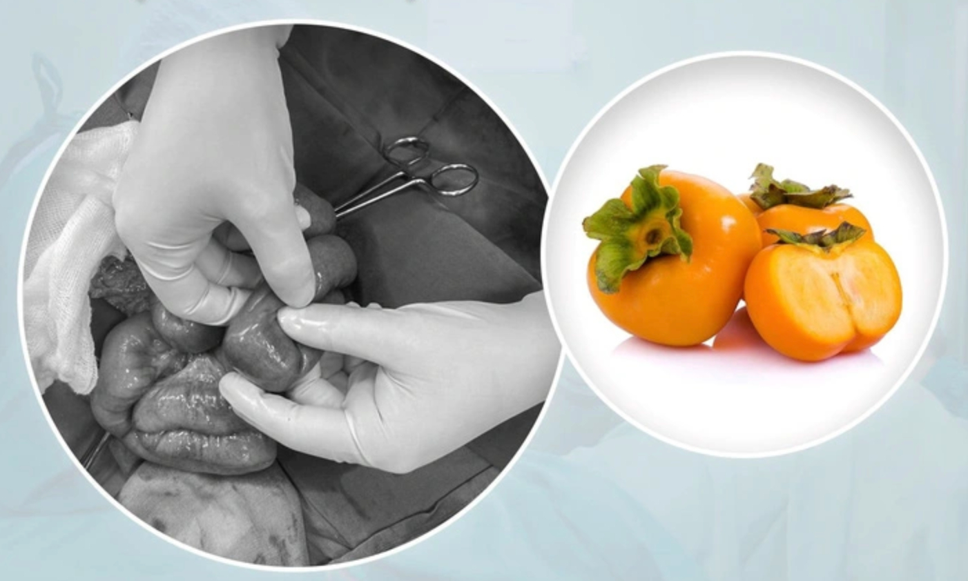 Mùa thu ăn hồng, phòng ngừa tắc ruột