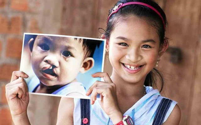 Phẫu thuật hở hàm ếch với chi phí 0 đồng