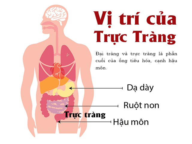 Alô, bác sĩ ơi! Ung thư đại tràng có di truyền không?