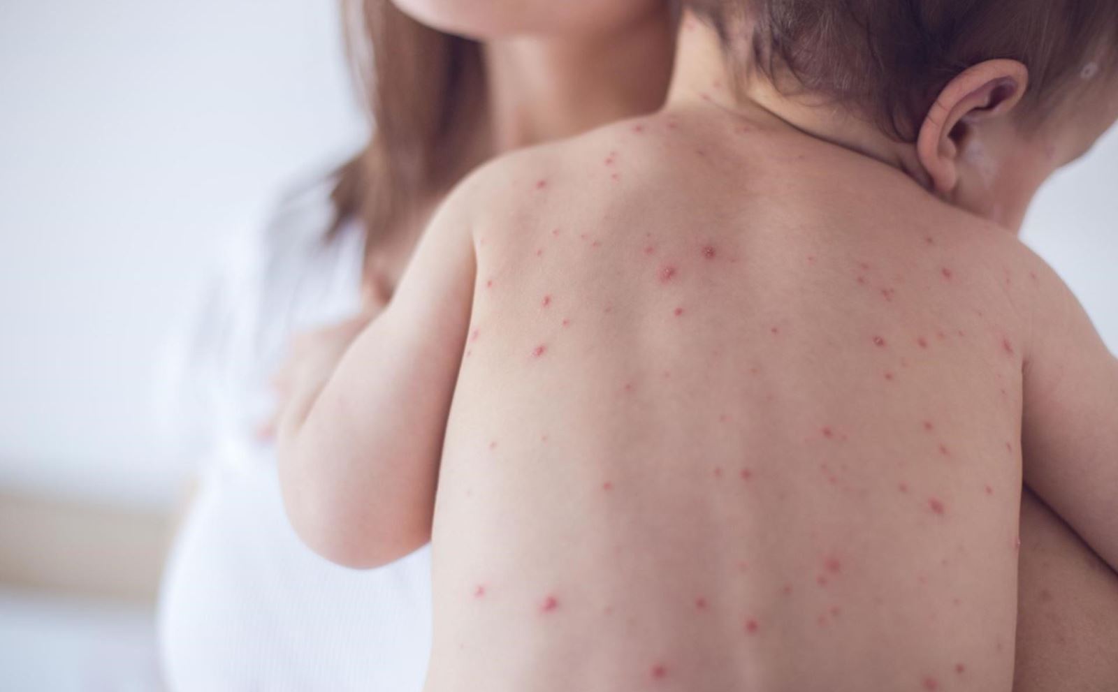 Bệnh đậu mùa khỉ: Cà Mau có chỉ đạo “nóng”