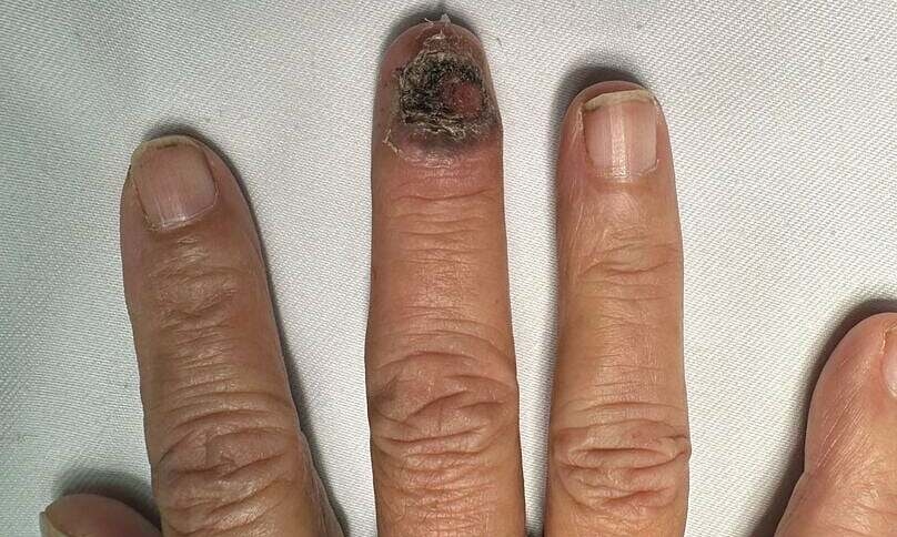 Nhận biết và phòng tránh loại ung thư da ác tính nhất