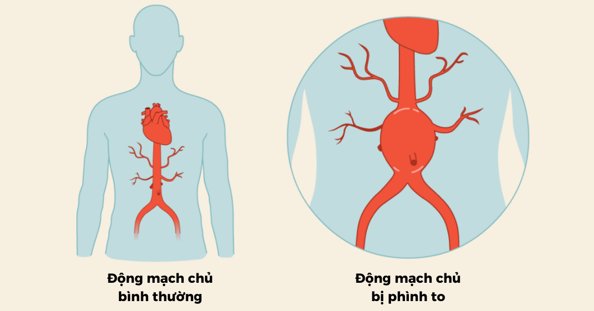 Ca mổ gần 5 tiếng cứu sống người đàn ông bị phình vỡ động mạch chậu