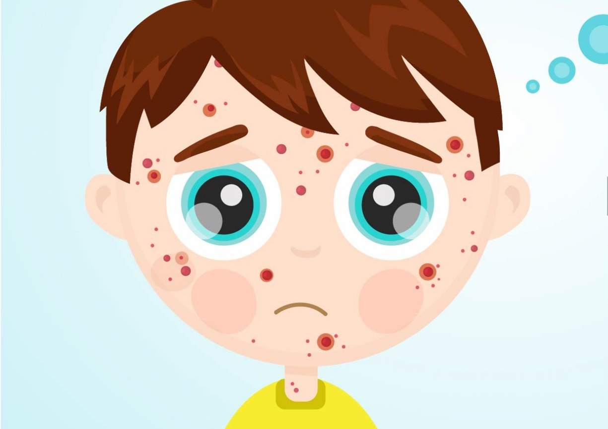 Đã có 42 ca mắc bệnh sởi, Bộ Y tế yêu cầu giám sát phát hiện sớm, xử lý triệt để ổ dịch