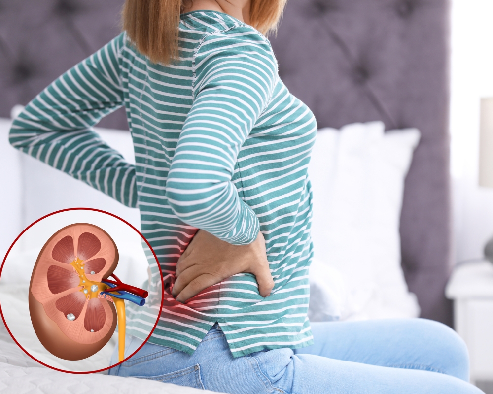 Sỏi thận: Nguyên nhân, triệu trứng và cách phòng ngừa