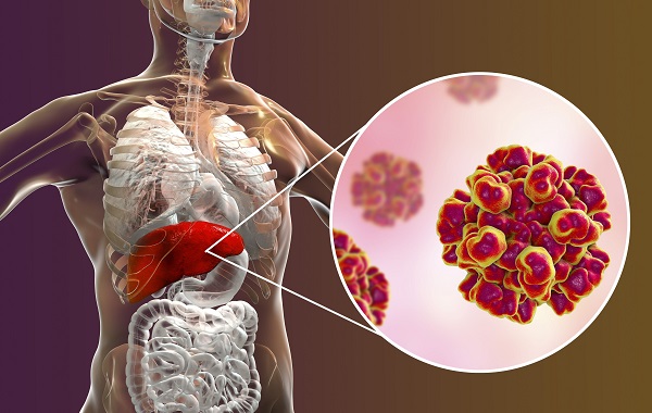 Thế giới có 1,3 triệu người chết mỗi năm vì viêm gan siêu vi