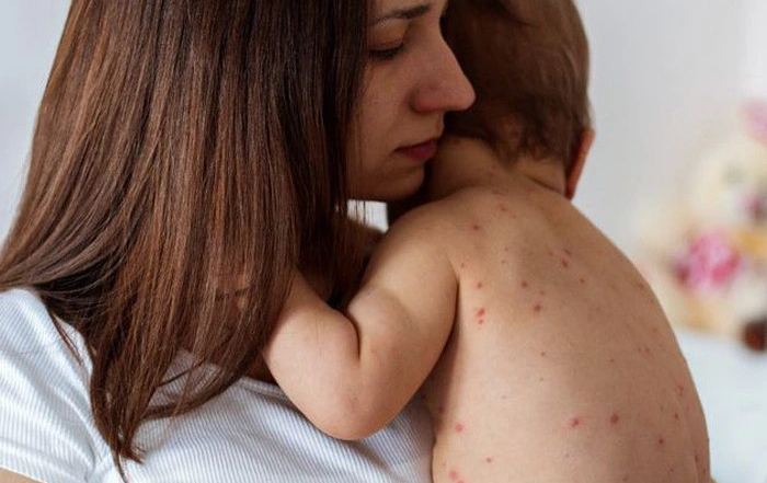 TP.HCM phát hiện nhiều ổ dịch sốt xuất huyết, nguy cơ bùng phát bệnh sởi