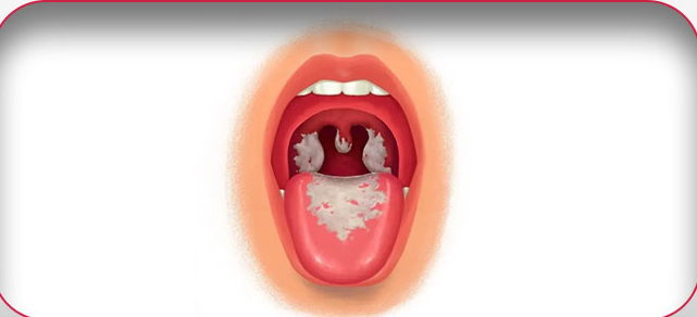 Bệnh bạch hầu có lây truyền qua đường tình dục?