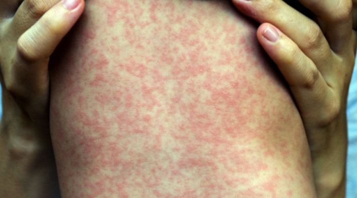 Số ca mắc sởi tăng gấp 8 lần, Bộ Y tế đưa ra 5 biện pháp phòng chống