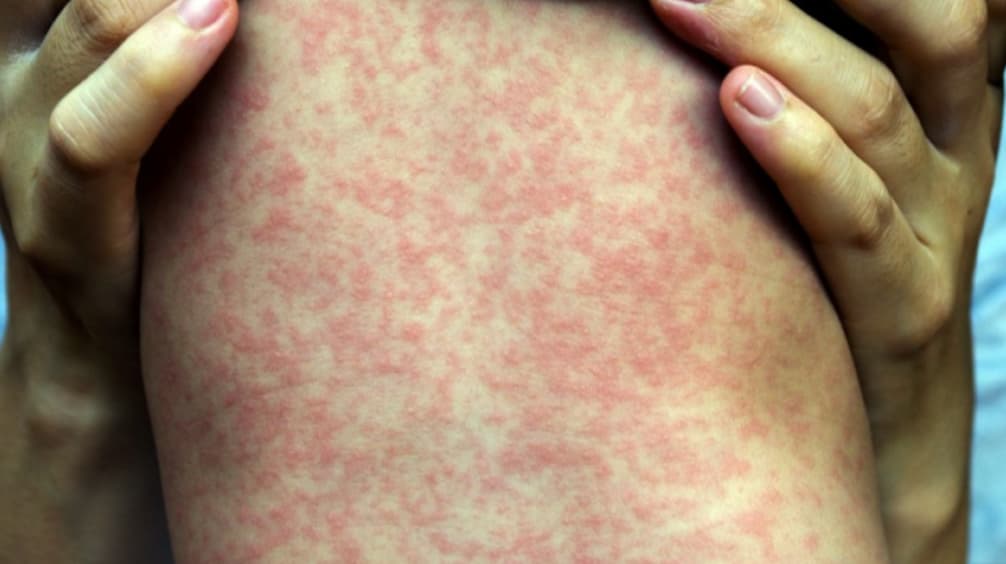 Bộ Y tế nói gì về việc TPHCM công bố dịch sởi trên địa bàn?