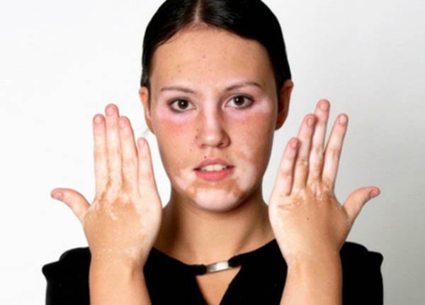 Câu hỏi thường gặp liên quan đến bệnh bạch biến