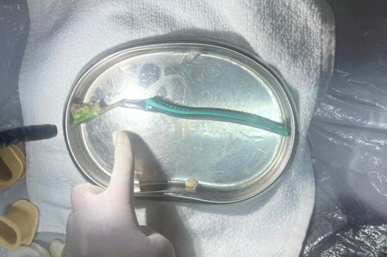 Hi hữu: Người phụ nữ Hải Dương nuốt phải bàn chải khi đang đánh răng