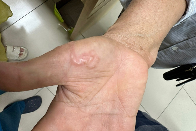 Giun đũa làm tổ trong cơ thể vì nuôi 8 con chó mèo