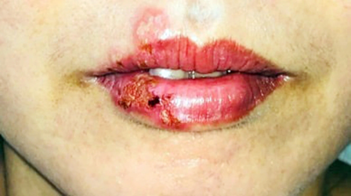 Nguy cơ biến chứng khi xăm hình: Cảnh báo từ các chuyên gia