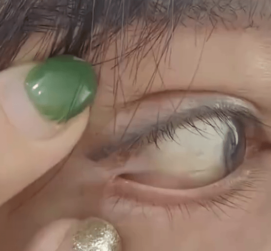 Bỏ 105 triệu cắt mắt 2 mí, người phụ nữ kinh hoàng phát hiện…