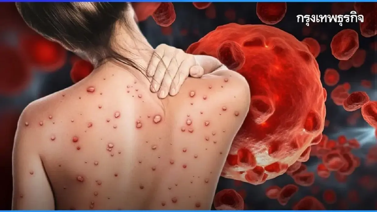 Mỹ bùng phát Covid-19, Bỉ có gần 900 ổ dịch bệnh lưỡi xanh, Thái Lan ngăn lan dịch đậu mùa khỉ