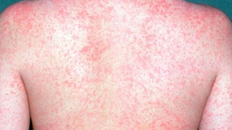 Cách xử lý, giải quyết và phòng ngừa bệnh sởi