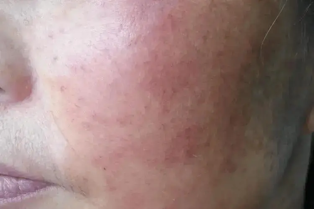 Thói quen tắm rửa không đúng cách có thể gây ung thư da