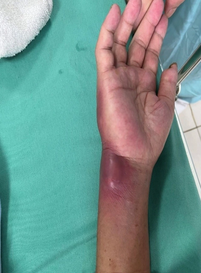 2 người bị nhiễm vi khuẩn “ăn thịt người” tại Hòa Bình