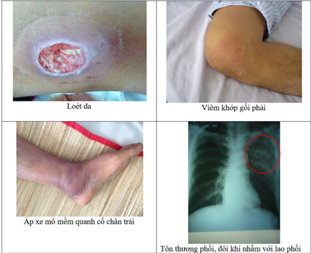 Vì sao Whitmore lại được mệnh danh là “bệnh vi khuẩn ăn thịt người”?