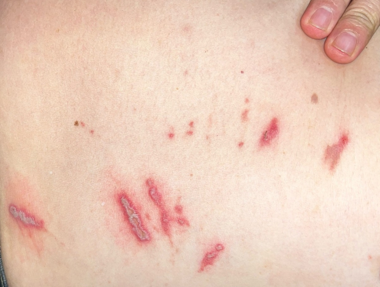 Độc tố của kiến ba khoang đáng sợ như thế nào?