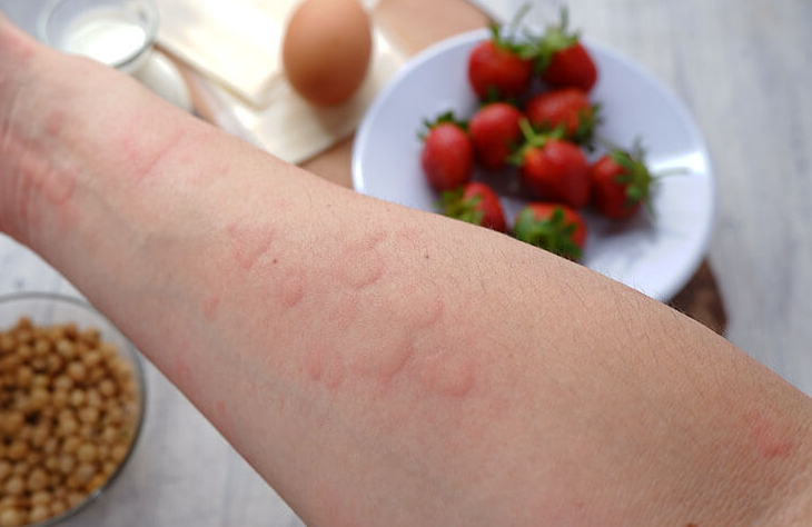 Triệu chứng và cơ chế gây sốc phản vệ?