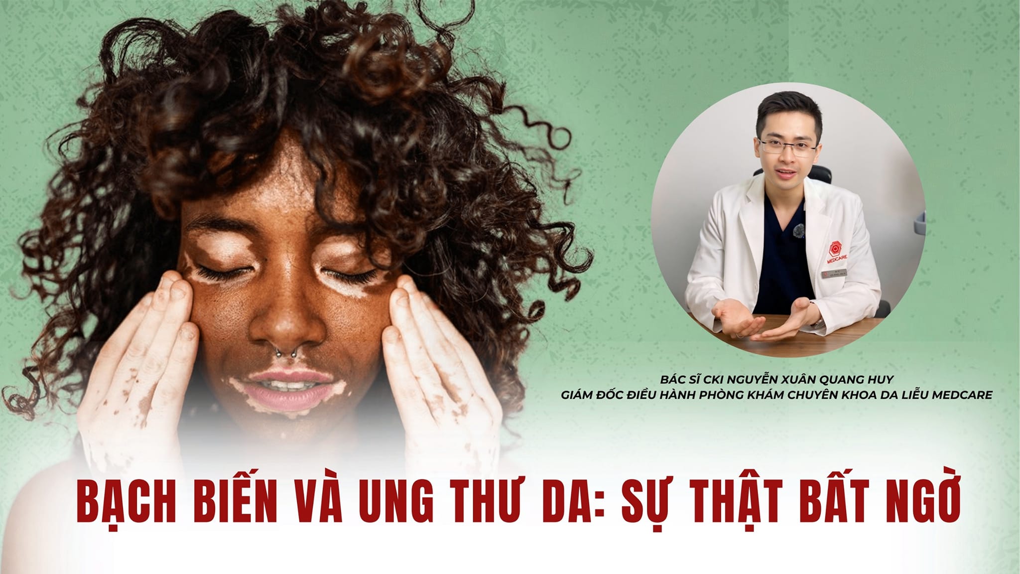 Bạch biến và ung thư da: sự thật bất ngờ