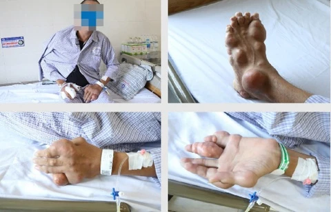 Tứ chi biến dạng kinh hoàng của người đàn ông mắc bệnh gout