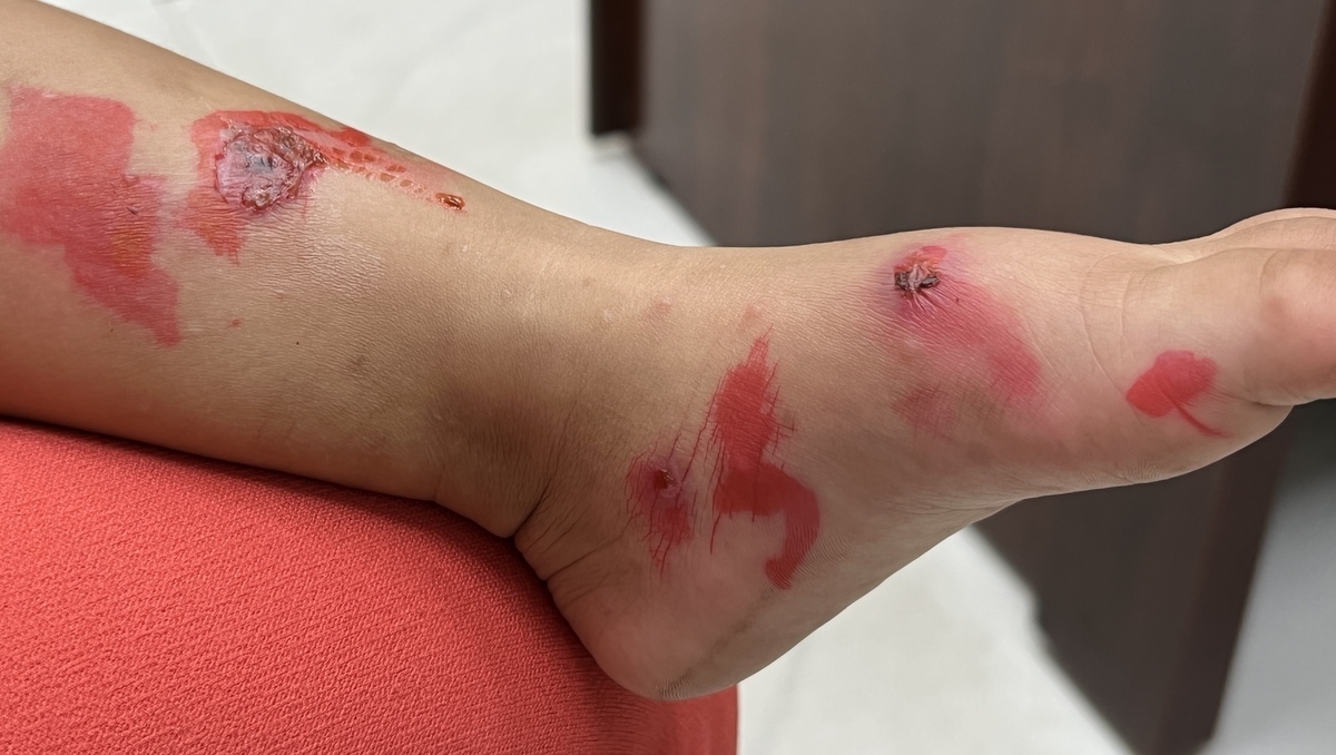 Số ca trẻ mắc bệnh chốc gia tăng, cảnh báo nguy cơ lây nhiễm tại trường học