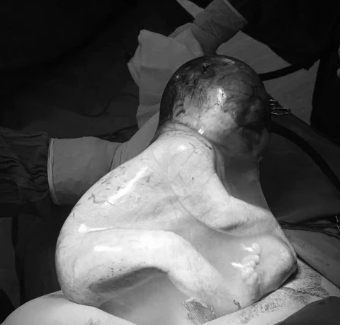 Em bé chào đời trong bọc điều khiến các bác sĩ ngạc nhiên