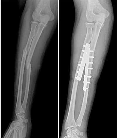 Chơi vật tay, nam thanh niên tập gym bị gãy tay