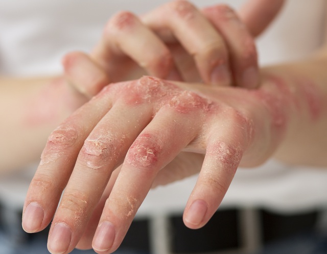 Phòng ngừa bệnh ngoài da sau mưa lũ: Những bệnh thường gặp do nhiễm khuẩn từ nước ngập