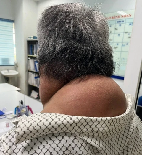 Người đàn ông mắc bệnh hiếm gặp do thói quen xấu