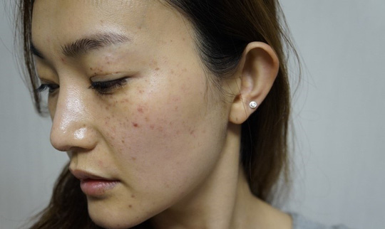 Yêu bản thân – Kì 2: Tàn nhang là phong ấn hay dấu ấn của sự tự tin?