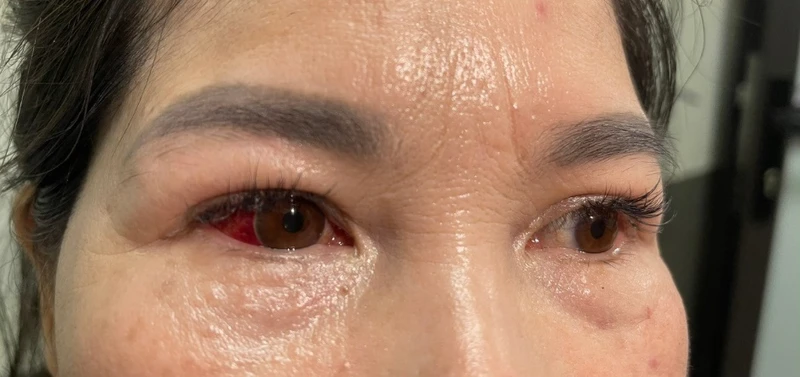 Hội chứng viêm kết mạc cấp mùa mưa lũ