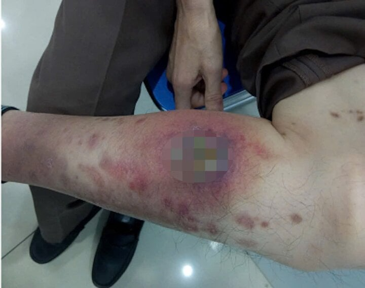 Lở loét cơ thể, nhập viện cấp cứu do ‘tự làm bác sĩ’ tại nhà