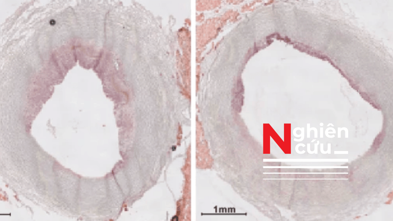 Đột phá trong điều trị tim mạch: Liệu pháp hạt nano giúp giảm mảng bám trong động mạch