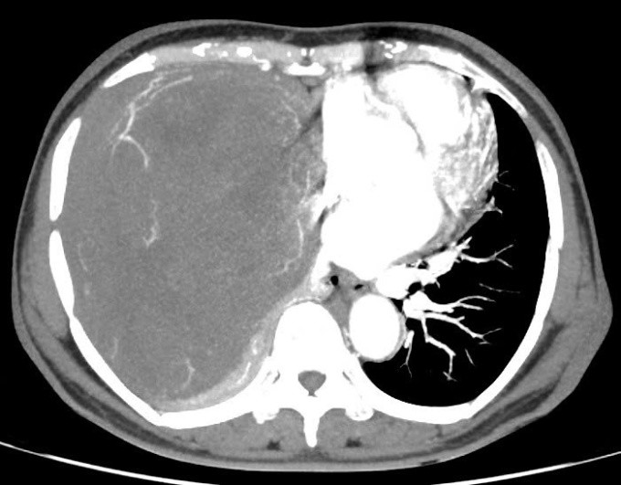 Đọc báo giùm bạn 1/10/2024: Khối u 2kg đè xẹp phổi. Bỏng nặng vì giác hơi bụng để chữa ung thư. Xăm hồng nhủ hoa dẫn đến nhiễm trùng