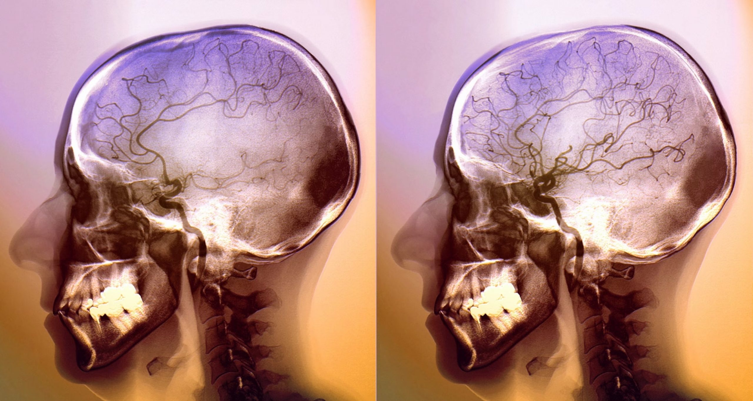 Đột quỵ đang gia tăng và đây là nguyên nhân chính