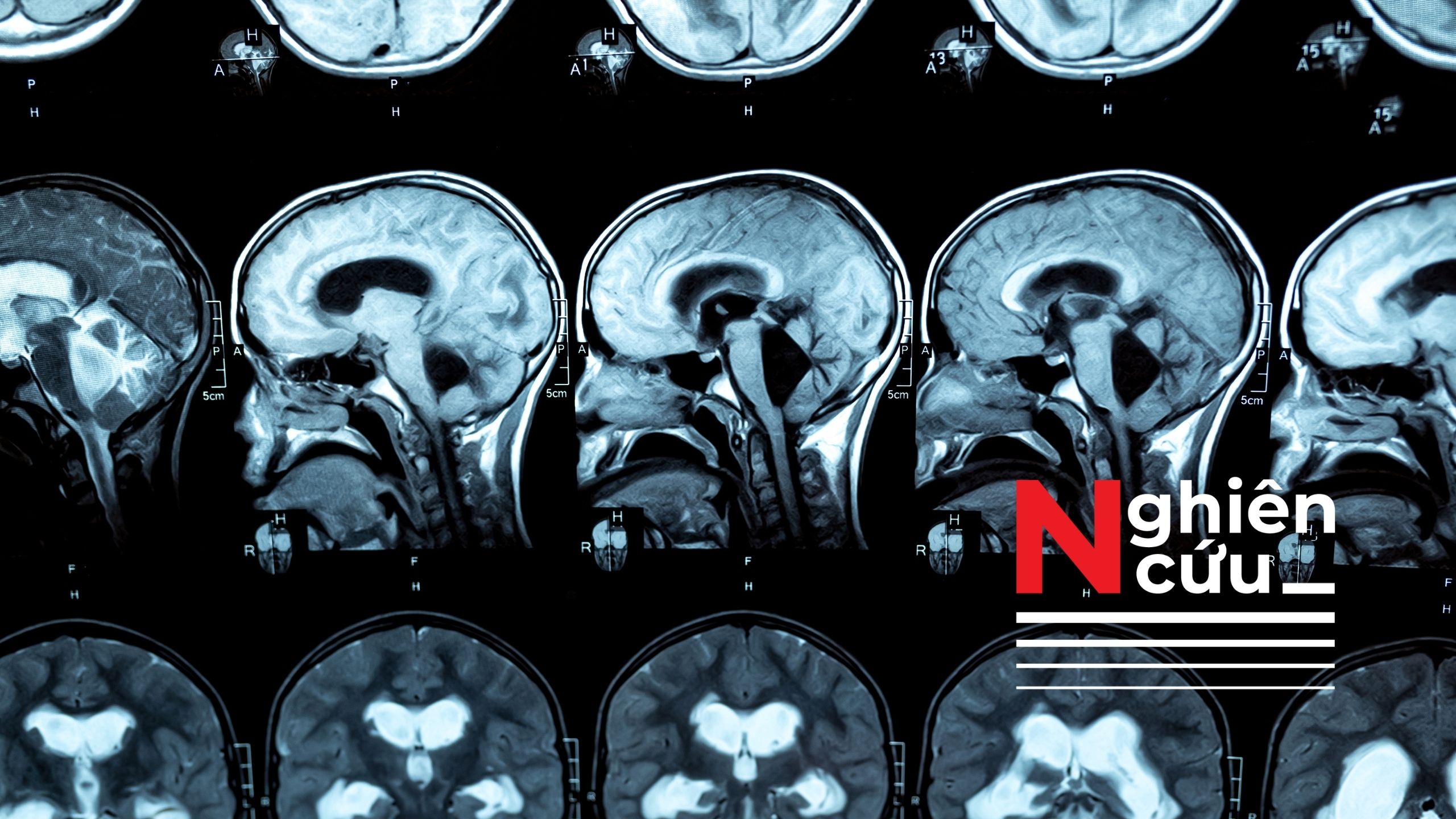 Chế độ ăn giúp giảm sắt trong não có thể làm chậm suy giảm nhận thức