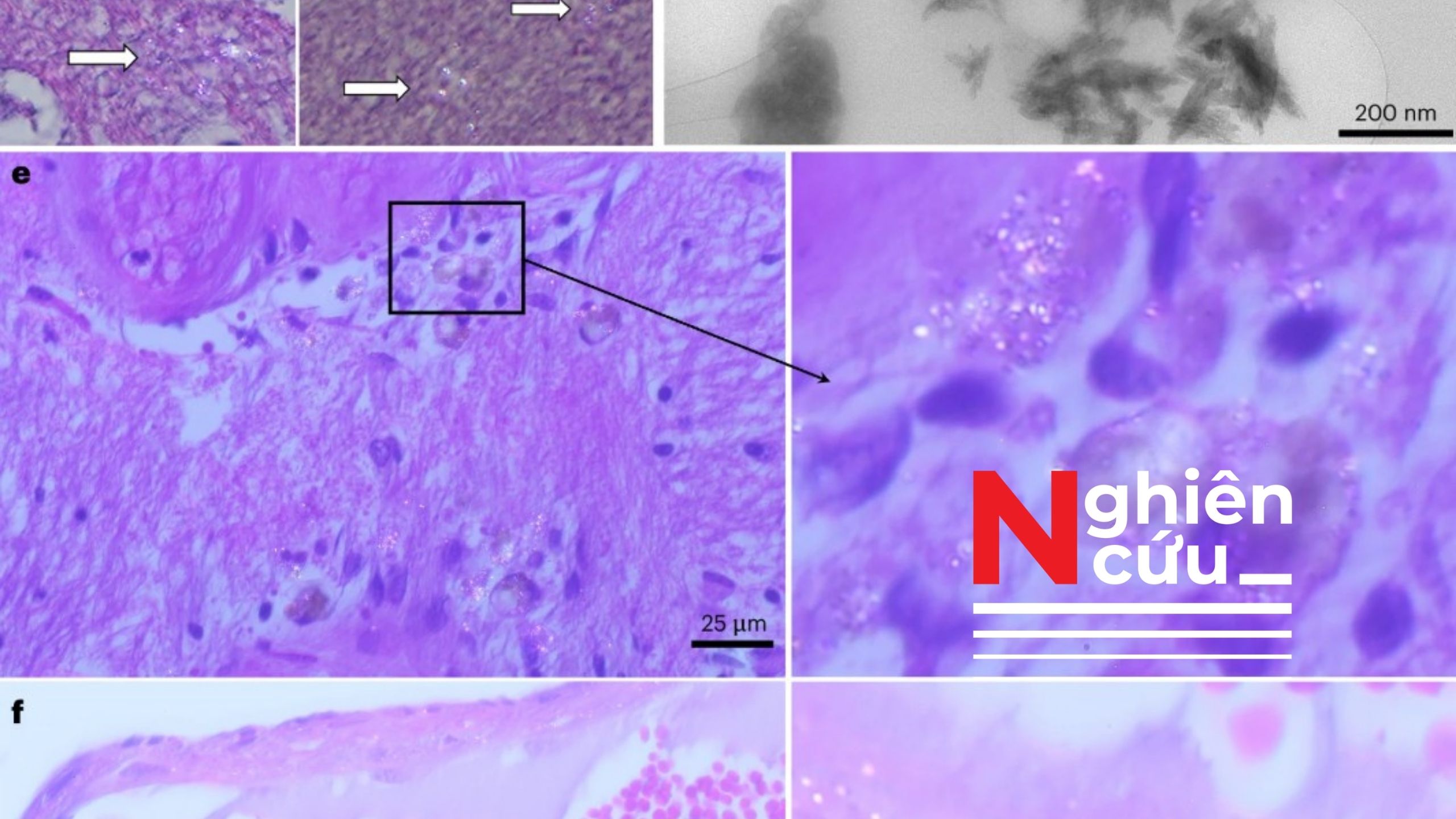 Vi nhựa trong não cao gấp 30 lần trong gan và thận