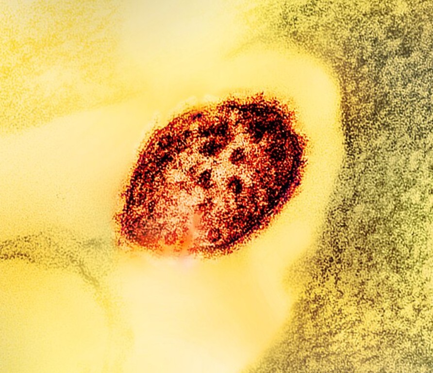 Sởi không đơn thuần là nổi mẩn đỏ mà còn gây ra những di chứng lâu dài